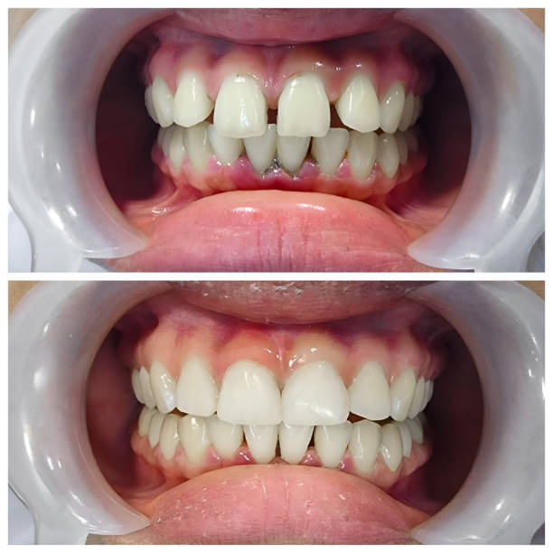 Best Full Mouth Reconstruction  in Batesville, AR